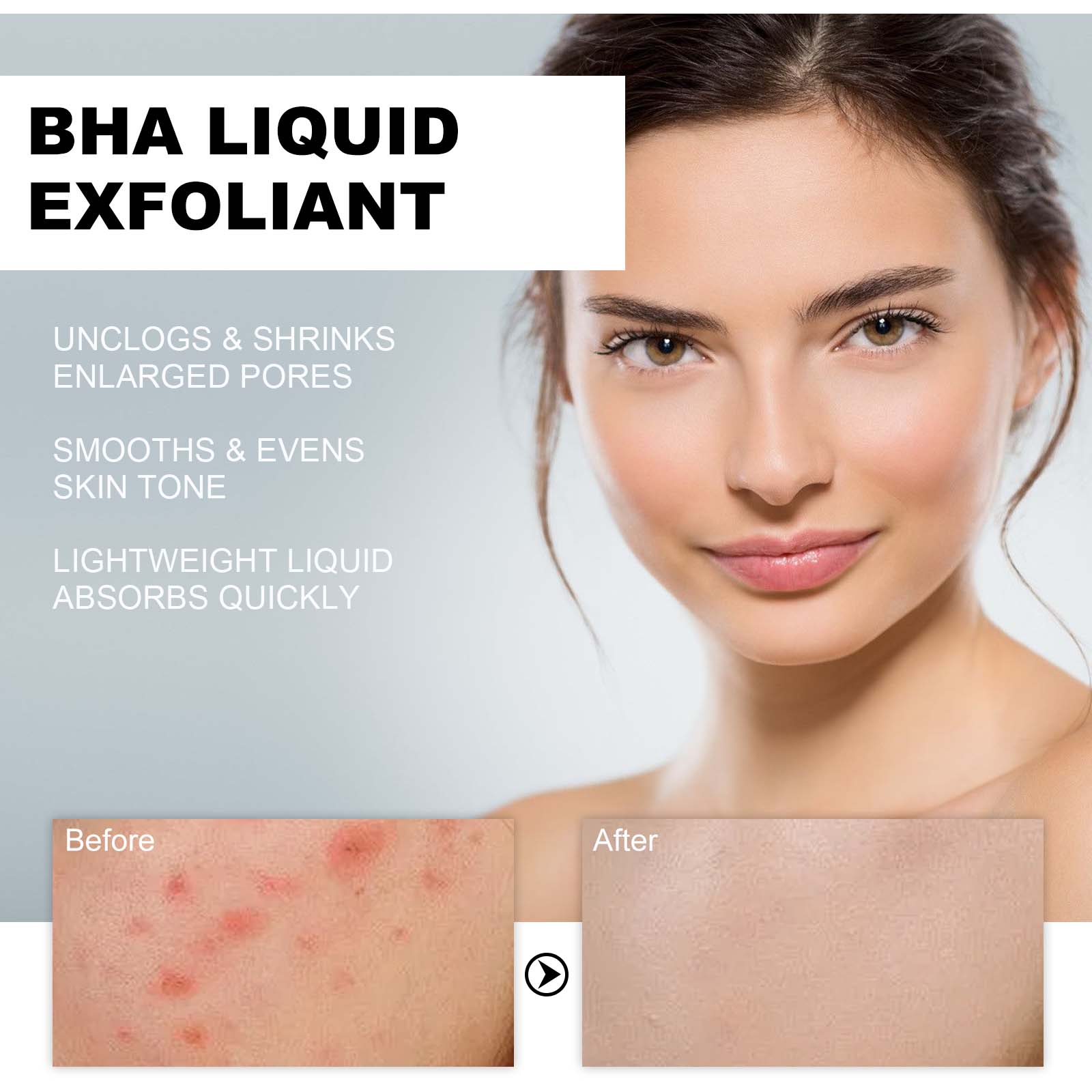 2% ซาลิไซลิก แอซิด ลิควิด เอ็ก - Tranexamic Acid Serum บทวิจารณ์และราคา