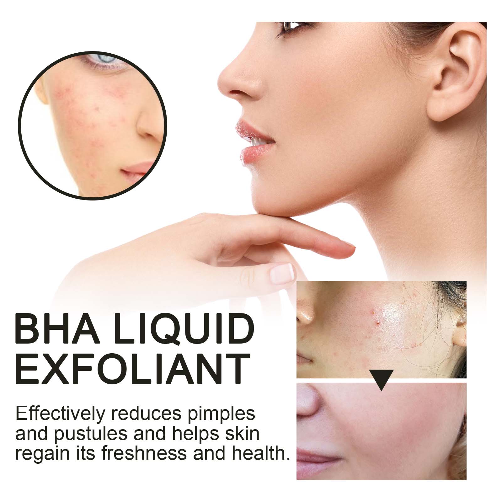2% ซาลิไซลิก แอซิด ลิควิด เอ็ก - Tranexamic Acid Serum บทวิจารณ์และราคา